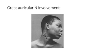 Great auricular N involvement
 
