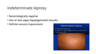 Indeterminate leprosy
• Bacteriologically negative
• One or two vague hypopigmented macules
• Definite sensory impairement
 