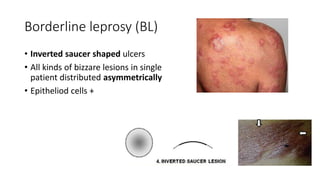 Borderline leprosy (BL)
• Inverted saucer shaped ulcers
• All kinds of bizzare lesions in single
patient distributed asymmetrically
• Epitheliod cells +
 