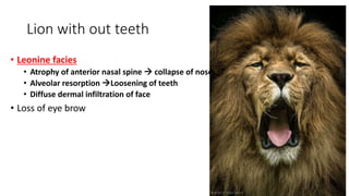Lion with out teeth
• Leonine facies
• Atrophy of anterior nasal spine  collapse of nose
• Alveolar resorption Loosening of teeth
• Diffuse dermal infiltration of face
• Loss of eye brow
 