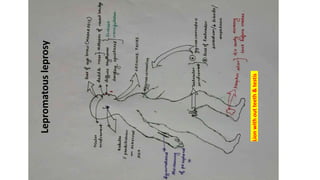 Lepromatousleprosy
Lionwithoutteeth&testis
 