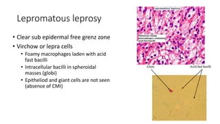 Lepromatous leprosy
• Clear sub epidermal free grenz zone
• Virchow or lepra cells
• Foamy macrophages laden with acid
fast bacilli
• Intracellular bacilli in spheroidal
masses (globi)
• Epitheliod and giant cells are not seen
(absence of CMI)
 