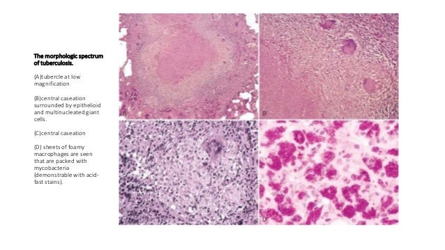 Mycobacterial diseases
