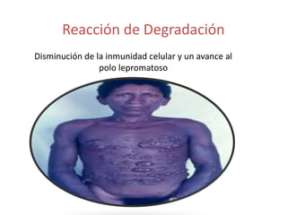 Reacción de Degradación
Disminución de la inmunidad celular y un avance al
polo lepromatoso
 
