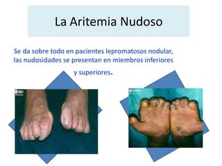 La Aritemia Nudoso
Se da sobre todo en pacientes lepromatosos nodular,
las nudosidades se presentan en miembros inferiores
y superiores.
 
