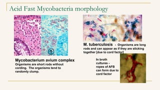 Acid Fast Mycobacteria morphology
Mycobacterium avium complex
Organisms are short rods without
cording. The organisms tend to
randomly clump.
M. tuberculosis - Organisms are long
rods and can appear as if they are sticking
together [due to cord factor]
In broth
cultures -
ropes of AFB
can form due to
cord factor
 