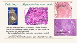 Pathology of Mycobacterium tuberculosis
Hallmark of Mycobacterium tuberculosis infected tissue is
necrotizing granulomatous inflammation, but non-necrotizing
granulomas can also be present
• Composed of epithelioid histiocytes surrounding a central
necrotic zone
• Variable number of multinucleated giant cells and lymphocytes.
Nodule with
cavitation
Necrotizing
granuloma
Non-necrotizing
granuloma
 