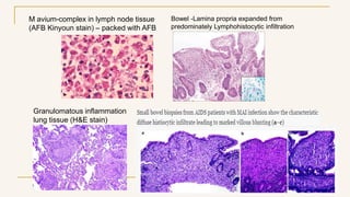 M avium-complex in lymph node tissue
(AFB Kinyoun stain) – packed with AFB
Granulomatous inflammation
lung tissue (H&E stain)
Bowel -Lamina propria expanded from
predominately Lymphohistocytic infiltration
 