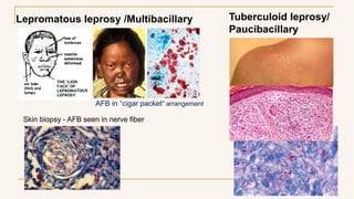 Tuberculoid leprosy/
Paucibacillary
Lepromatous leprosy /Multibacillary
Skin biopsy - AFB seen in nerve fiber
AFB in “cigar packet” arrangement
 