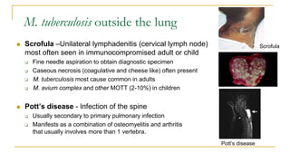 M. tuberculosis outside the lung
 Scrofula –Unilateral lymphadenitis (cervical lymph node)
most often seen in immunocompromised adult or child
 Fine needle aspiration to obtain diagnostic specimen
 Caseous necrosis (coagulative and cheese like) often present
 M. tuberculosis most cause common in adults
 M. avium complex and other MOTT (2-10%) in children
 Pott’s disease - Infection of the spine
 Usually secondary to primary pulmonary infection
 Manifests as a combination of osteomyelitis and arthritis
that usually involves more than 1 vertebra.
Pott’s disease
Scrofula
 