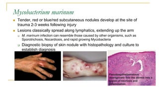 Mycobacterium marinum
 Tender, red or blue/red subcutaneous nodules develop at the site of
trauma 2-3 weeks following injury
 Lesions classically spread along lymphatics, extending up the arm
 M. marinum infection can resemble those caused by other organisms, such as
Sporotrichosis, Nocardiosis, and rapid growing Mycobacteria
 Diagnostic biopsy of skin nodule with histopathology and culture to
establish diagnosis
Pseudoepitheliomatous
downgrowth into the dermis into a
region of necrosis and
inflammation.
 