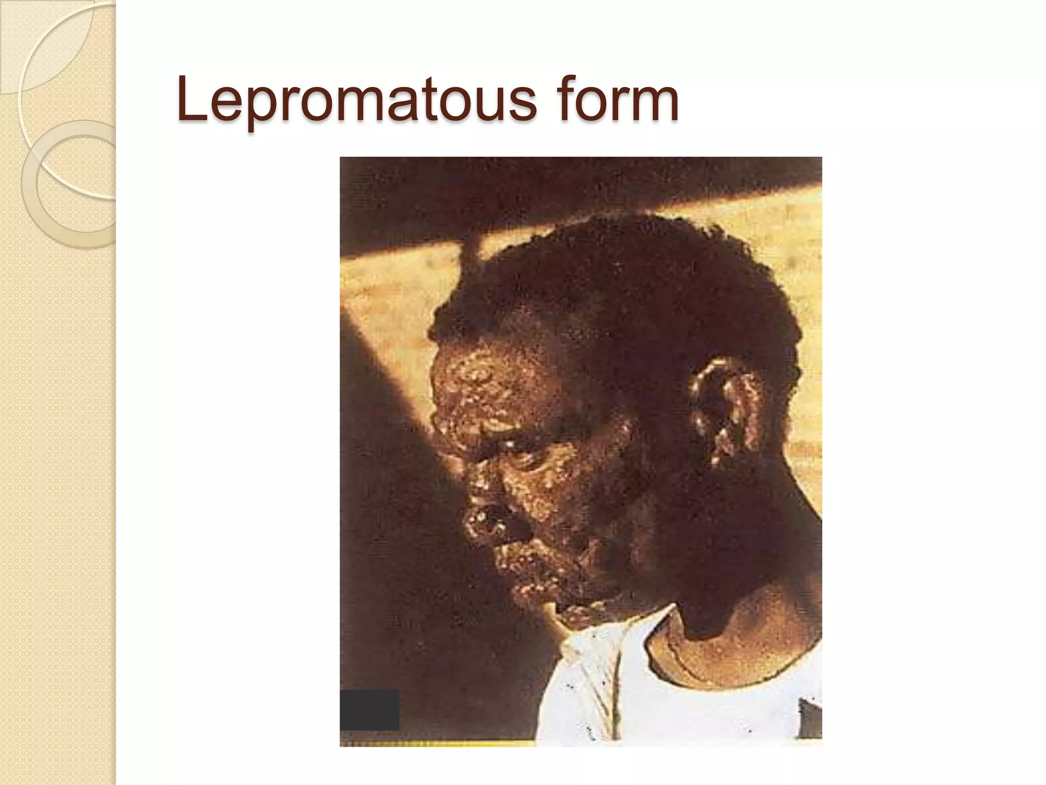 Lepromatous form
 