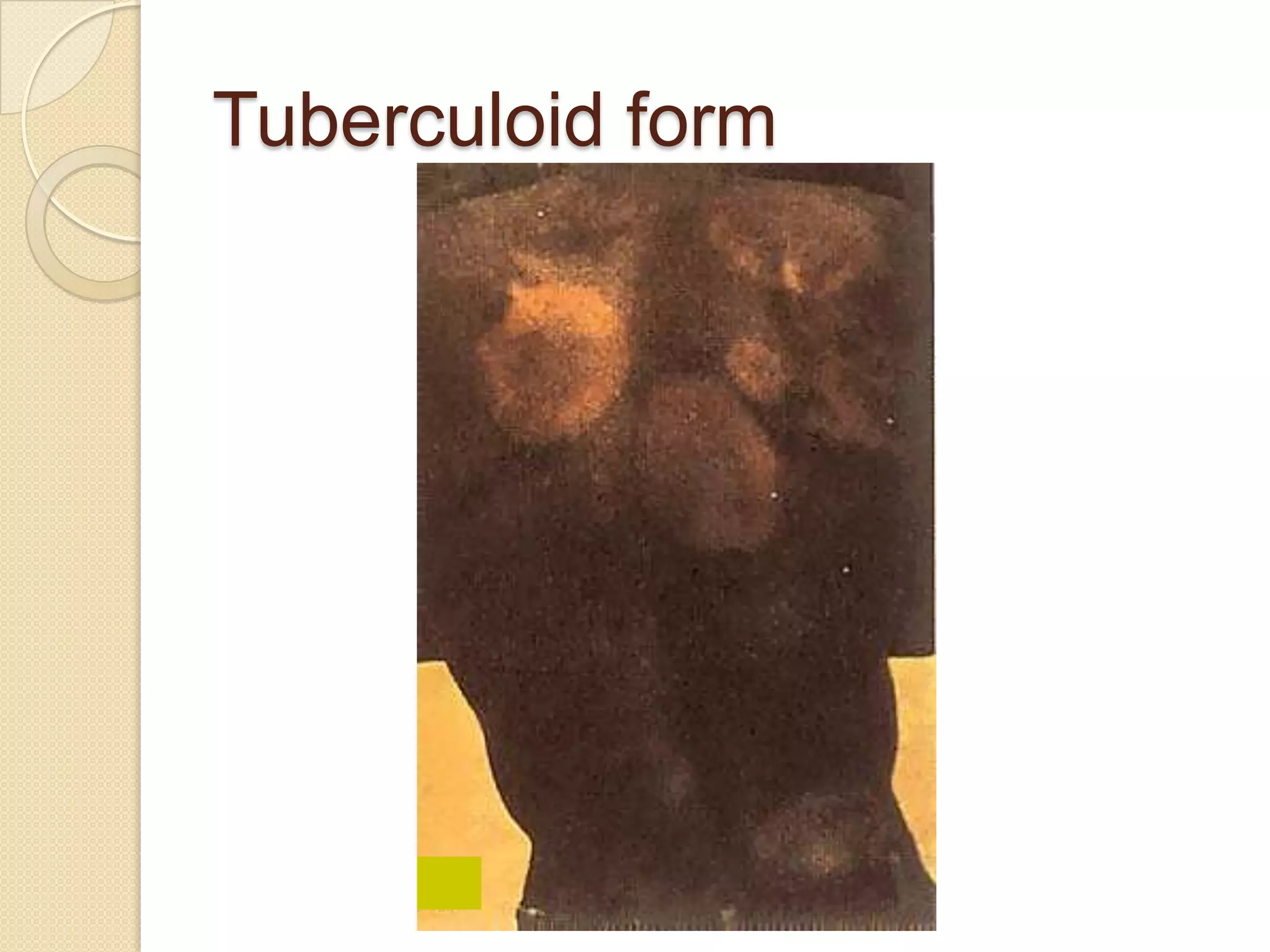 Tuberculoid form
 