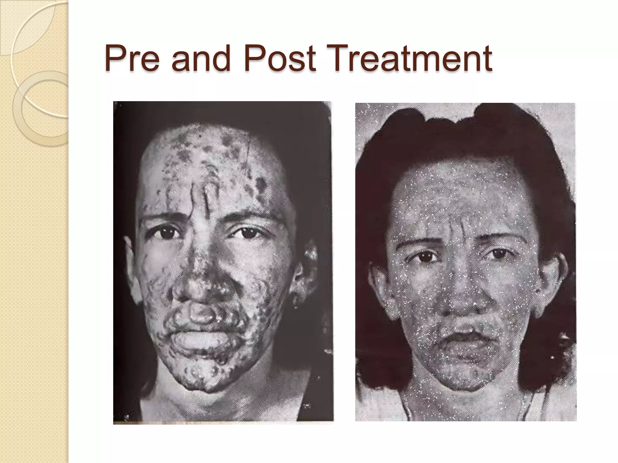 Pre and Post Treatment
 