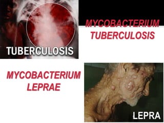 MYCOBACTERIUM
TUBERCULOSIS

MYCOBACTERIUM
LEPRAE
LEPRA

 