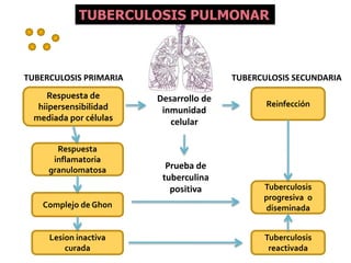 TUBERCULOSIS PULMONAR

TUBERCULOSIS PRIMARIA
Respuesta de
hiipersensibilidad
mediada por células
Respuesta
inflamatoria
granulomatosa

TUBERCULOSIS SECUNDARIA

Desarrollo de
inmunidad
celular

Prueba de
tuberculina
positiva

Reinfección

Complejo de Ghon

Tuberculosis
progresiva o
diseminada

Lesion inactiva
curada

Tuberculosis
reactivada

 