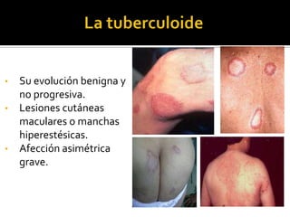 •
•

•

Su evolución benigna y
no progresiva.
Lesiones cutáneas
maculares o manchas
hiperestésicas.
Afección asimétrica
grave.

 