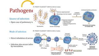 Pathogenesis 
Source of infection: 
 Open case of pulmonary tuberculosis 
Mode of infection 
 Direct inhalation of aerosolized bacilli contained in the droplet nuclei of expectorated sputum. 
 Infection also occurs infrequently by ingestion for example, through infected milk, and rarely 
by inoculation. 
 