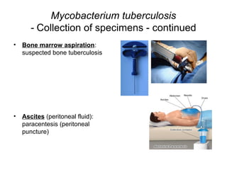 Mycobacterium tuberculosis
- Collection of specimens - continued
• Bone marrow aspiration:
suspected bone tuberculosis
• Ascites (peritoneal fluid):
paracentesis (peritoneal
puncture)
 