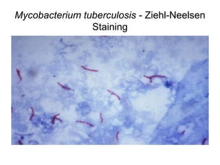 Mycobacterium tuberculosis - Ziehl-Neelsen
Staining
 