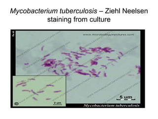 Mycobacterium tuberculosis – Ziehl Neelsen
staining from culture
 