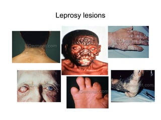 Leprosy lesions
 