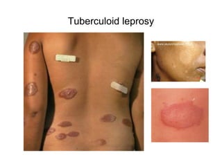 Tuberculoid leprosy
 