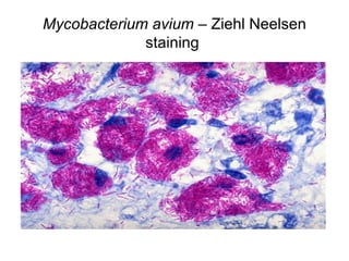 Mycobacterium avium – Ziehl Neelsen
staining
 