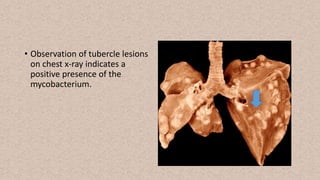 • Observation of tubercle lesions
on chest x-ray indicates a
positive presence of the
mycobacterium.
 