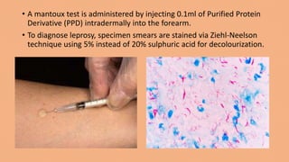 • A mantoux test is administered by injecting 0.1ml of Purified Protein
Derivative (PPD) intradermally into the forearm.
• To diagnose leprosy, specimen smears are stained via Ziehl-Neelson
technique using 5% instead of 20% sulphuric acid for decolourization.
 