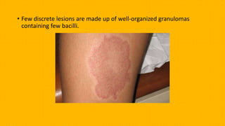 • Few discrete lesions are made up of well-organized granulomas
containing few bacilli.
 