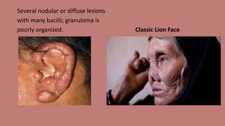 Several nodular or diffuse lesions
with many bacilli; granuloma is
poorly organized. Classic Lion Face
 