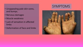 SYMPTOMS
• Unappealing pale skin sores,
and bumps.
• Nervous damages
• Muscle weakness
• Lack of sensation in affected
limbs
• Deformation of face and limbs
 