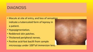DIAGNOSIS
• Macule at site of entry, and loss of sensation
indicate a tuberculoid form of leprosy in
a patient.
• Hypopigmentation.
• Reddened skin patches.
• Thickened peripheral nerves.
• Positive acid-fast bacilli from sample
microscopy under 100*oil immersion lens.
 