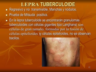 LEPRA TUBERCULOIDE
   Regresivo y no transmisible, Manchas y nódulos.
   Prueba de Mitsuda positiva.
   En la lepra tuberculoide se encontrarán granulomas
    tuberculoides con células gigantes tipo Langhans( son
    células de gran tamaño, formadas por la fusión de
    células epitelioides )y células epitelioides, no se observan
    bacilos.




                                                              12
 