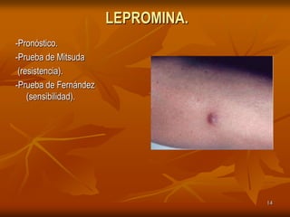 LEPROMINA.
-Pronóstico.
-Prueba de Mitsuda
 (resistencia).
-Prueba de Fernández
    (sensibilidad).




                                    14
 
