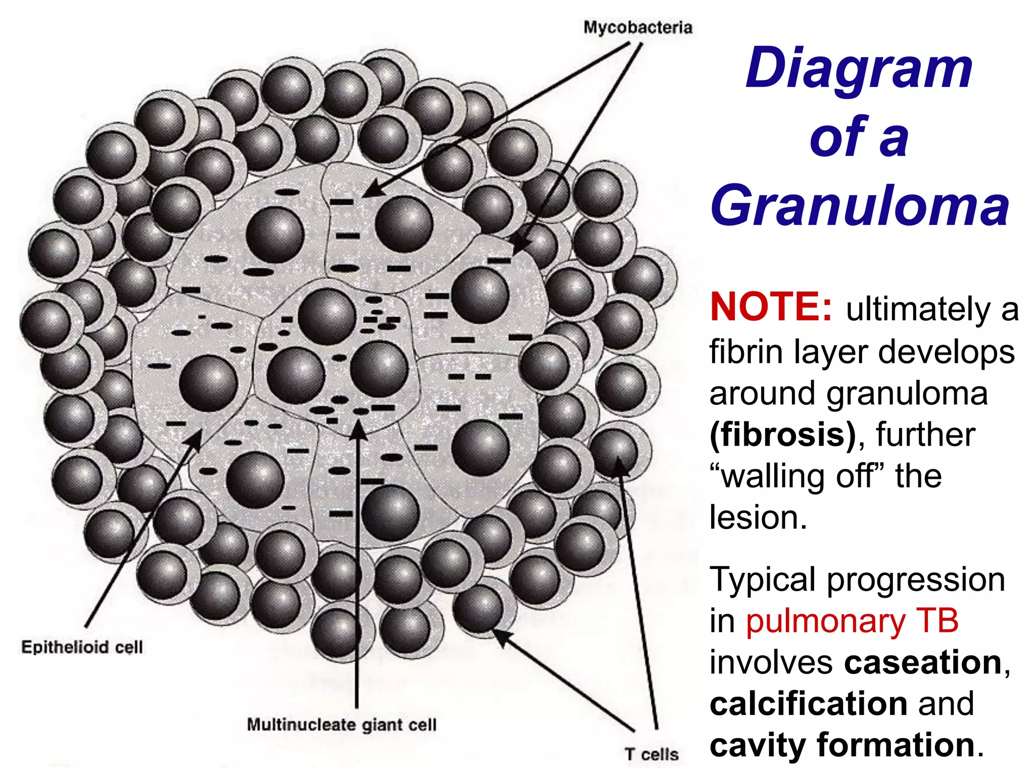 Diagram
of a
Granuloma
NOTE: ultimately a
fibrin layer develops
around granuloma
(fibrosis), further
“walling off” the
lesion.
Typical progression
in pulmonary TB
involves caseation,
calcification and
cavity formation.
 