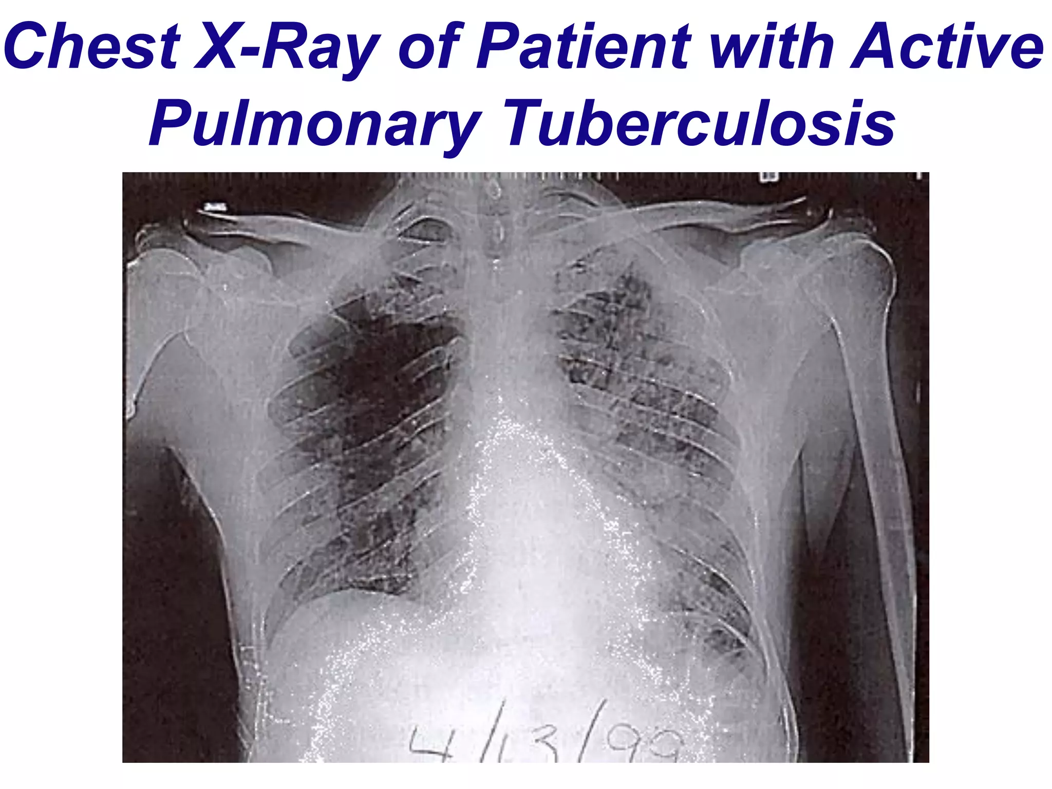 Chest X-Ray of Patient with Active
Pulmonary Tuberculosis
 