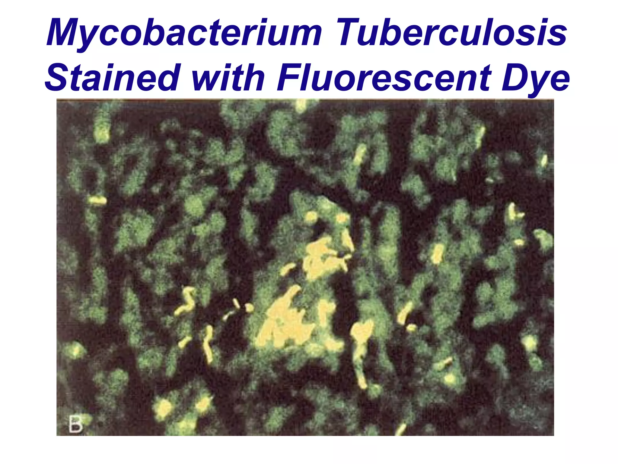 Mycobacterium Tuberculosis
Stained with Fluorescent Dye
 