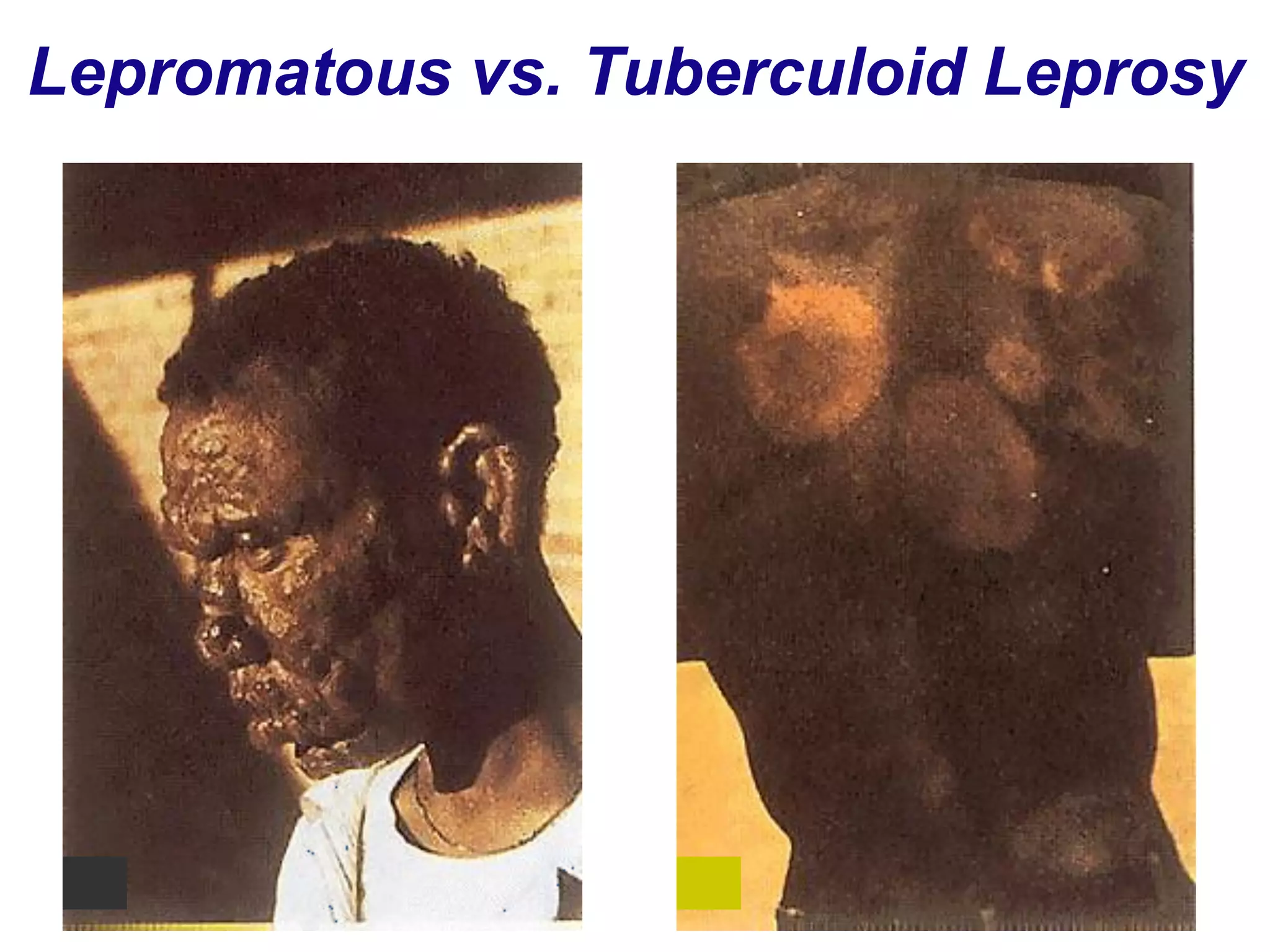 Lepromatous vs. Tuberculoid Leprosy
 