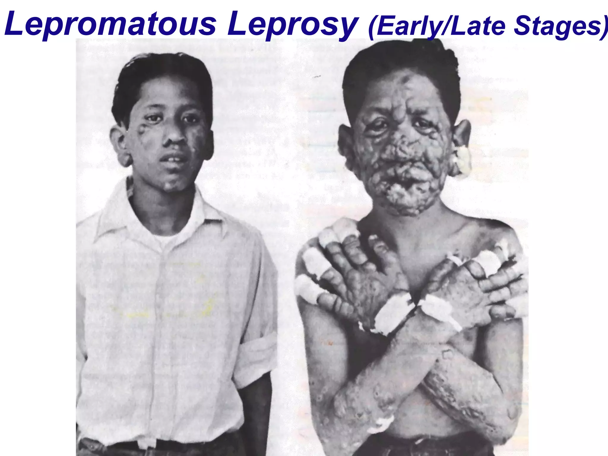 Lepromatous Leprosy (Early/Late Stages)
 