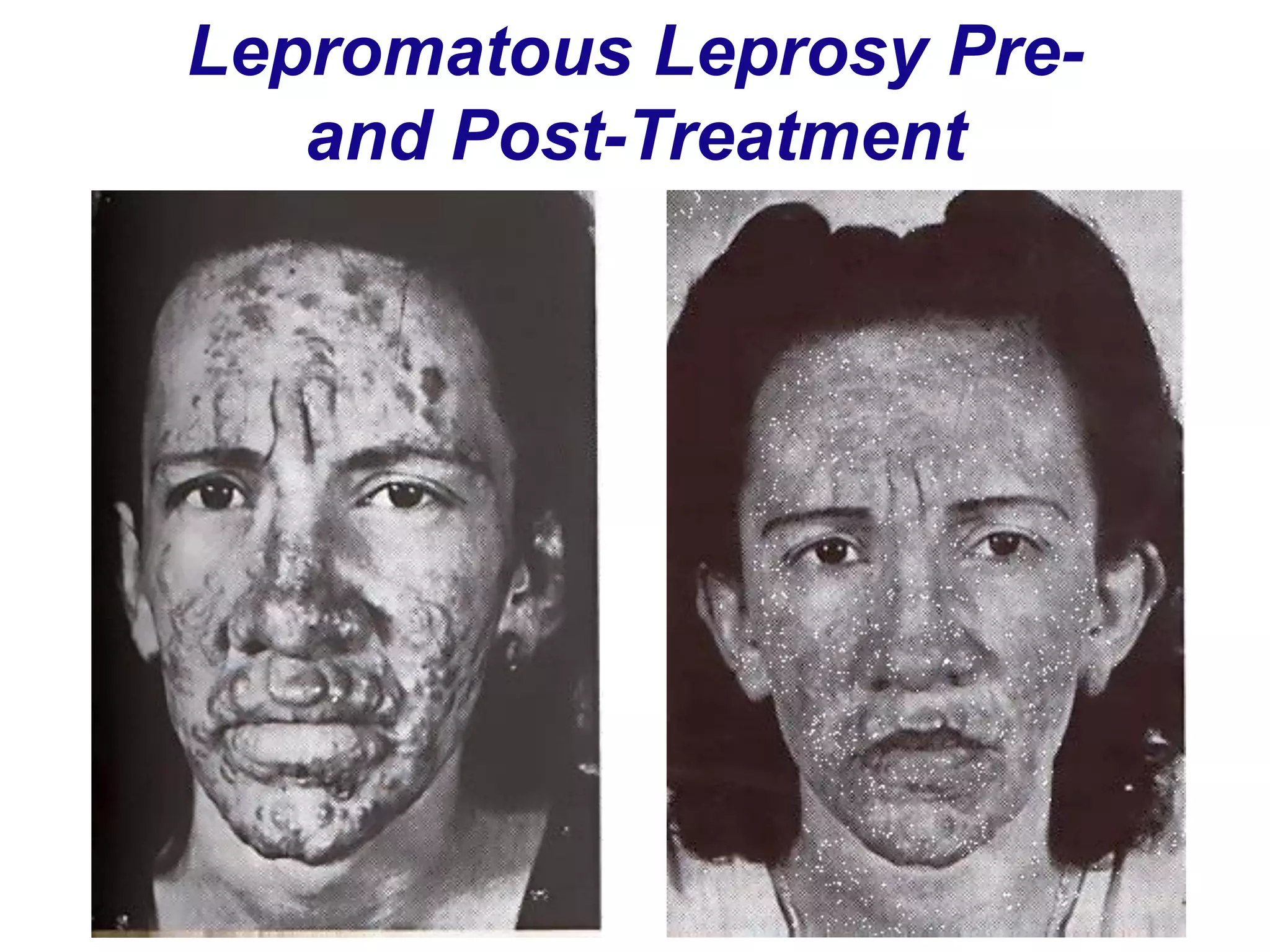 Lepromatous Leprosy Pre-
and Post-Treatment
 