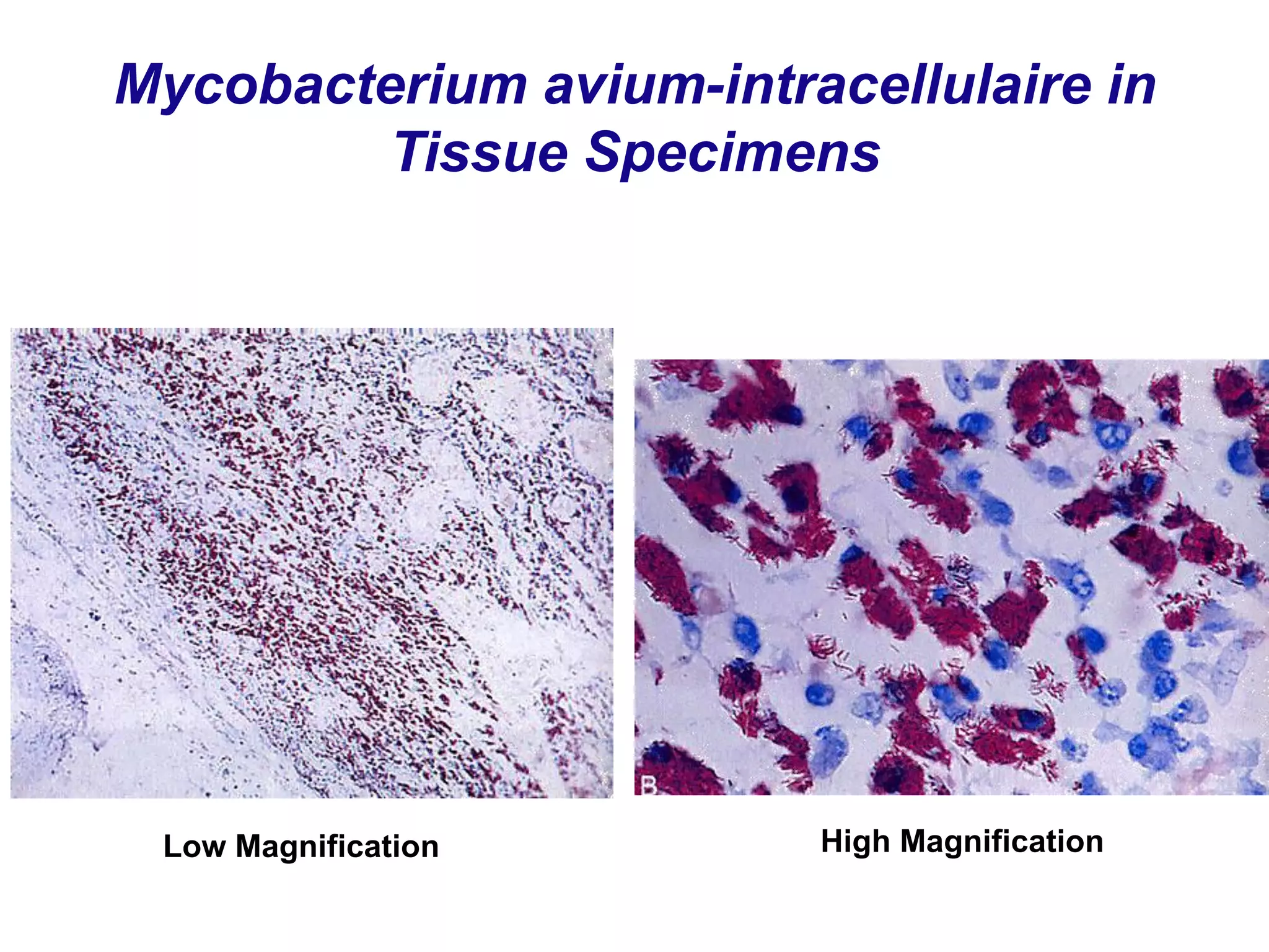 Mycobacterium avium-intracellulaire in
Tissue Specimens
Low Magnification High Magnification
 
