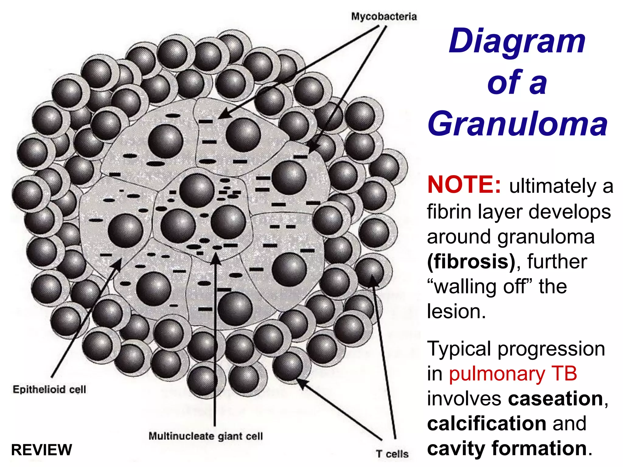 Diagram
of a
Granuloma
NOTE: ultimately a
fibrin layer develops
around granuloma
(fibrosis), further
“walling off” the
lesion.
Typical progression
in pulmonary TB
involves caseation,
calcification and
cavity formation.REVIEW
 