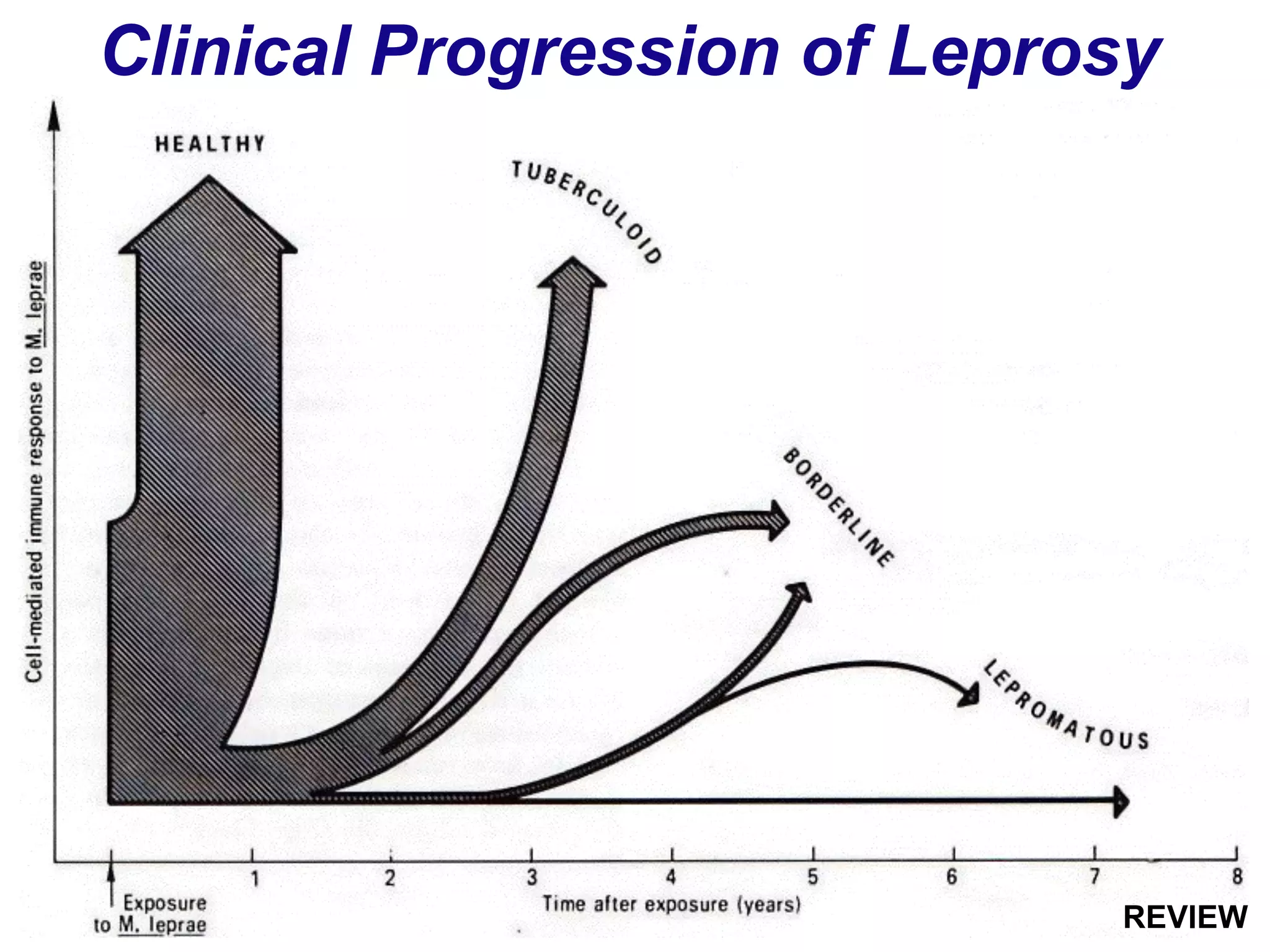 Clinical Progression of Leprosy
REVIEW
 