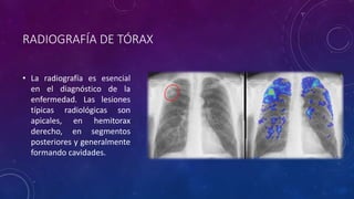 RADIOGRAFÍA DE TÓRAX 
• La radiografía es esencial 
en el diagnóstico de la 
enfermedad. Las lesiones 
típicas radiológicas son 
apicales, en hemitorax 
derecho, en segmentos 
posteriores y generalmente 
formando cavidades. 
 