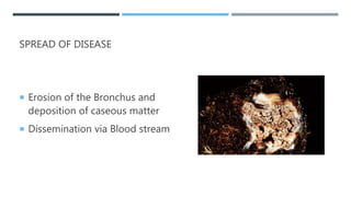 Caseation Hitopath Mycobacterium I.pptx
