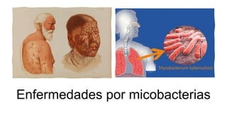 Enfermedades por micobacterias
 