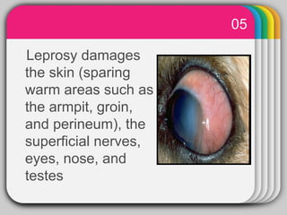 05
           WINTER
Leprosy damages
              Template
the skin (sparing
warm areas such as
the armpit, groin,
and perineum), the
superficial nerves,
eyes, nose, and
testes
 