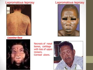 Lepromatous leprosy Lepromatous leprosy
Leonine face
Necrosis of nasal
bones, cartilage
with loss of upper
incisors.
Corneal ulcers.
 